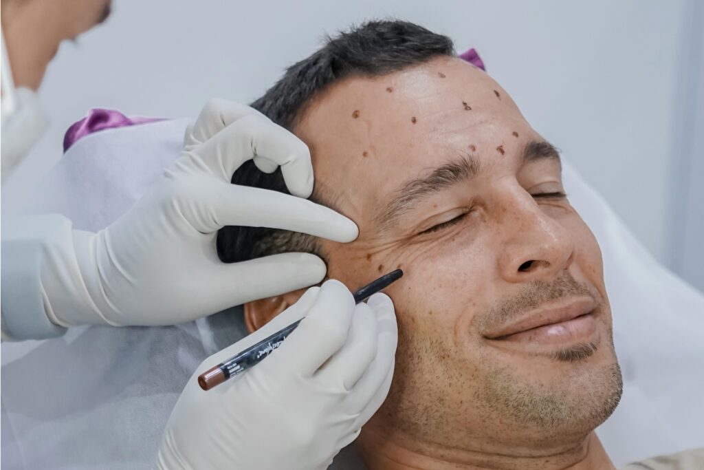 Is It Safe to Get Botox or Fillers in Bali?