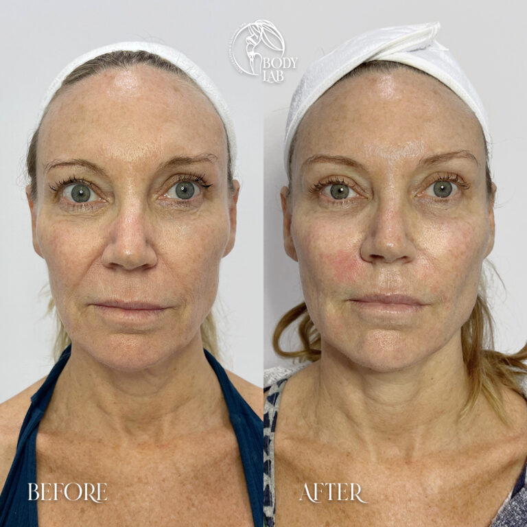 Collagen Stimulators