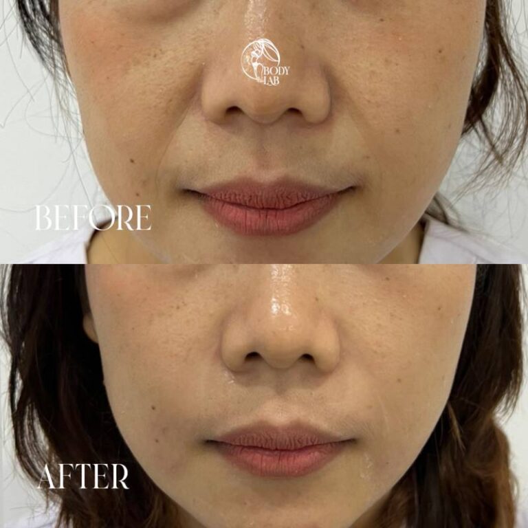 Smile Line Filler