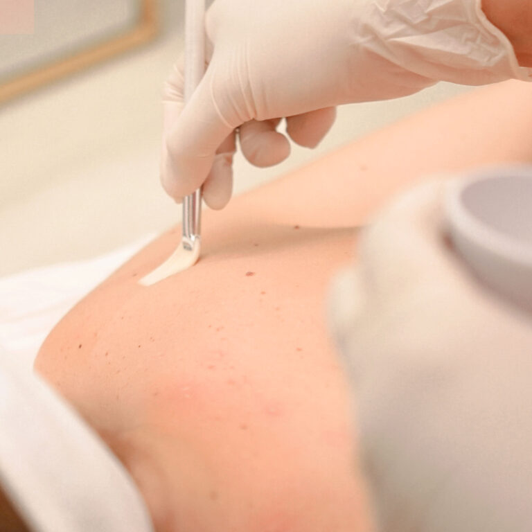 Anti Acne Peel for Back or Buttocks — Body Lab Bali