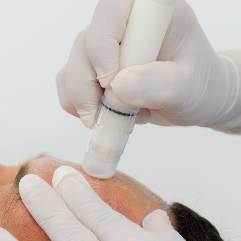 Microdermabrasion Express — Body Lab Bali