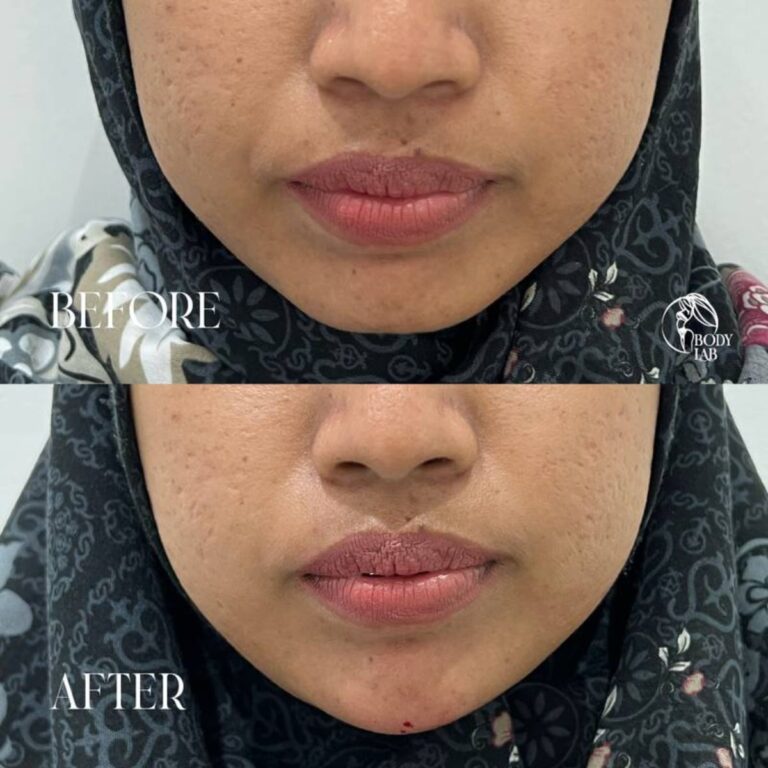 Chin Filler
