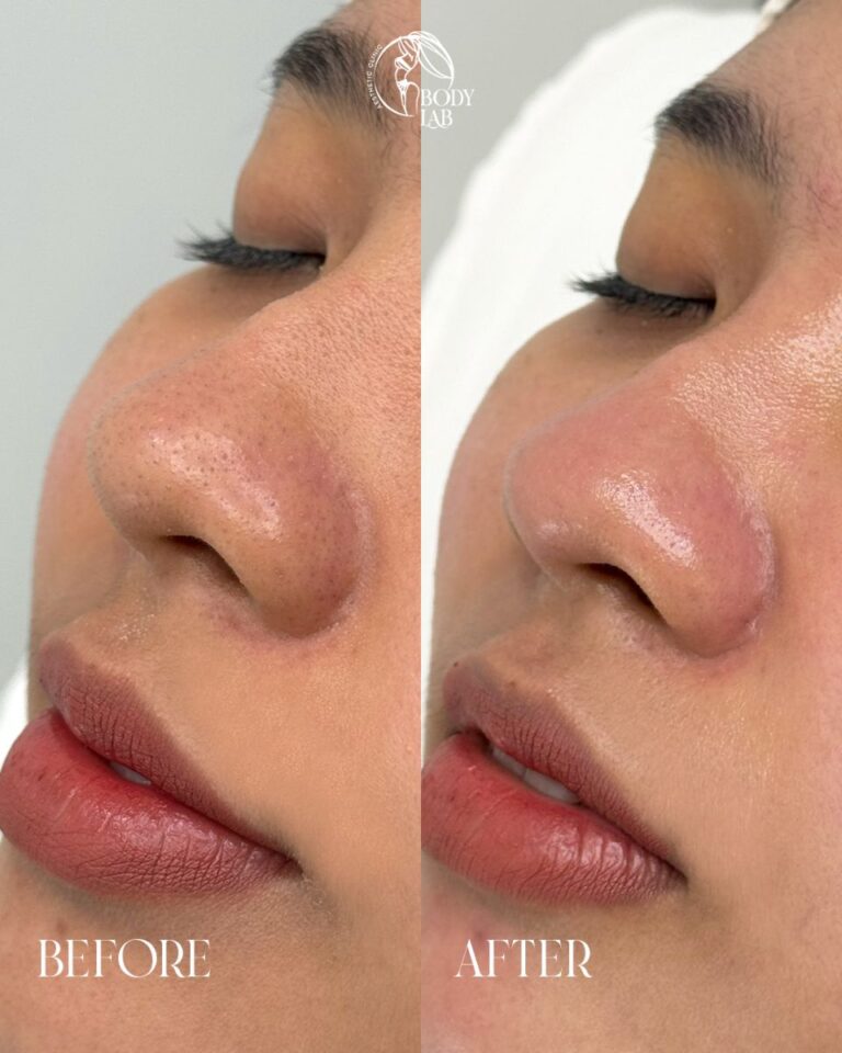 Detox Oxygen Facial