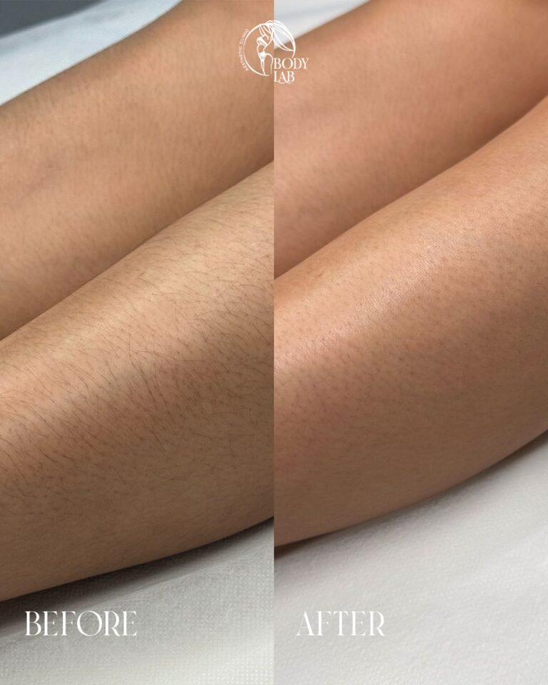Laser Hair Removal