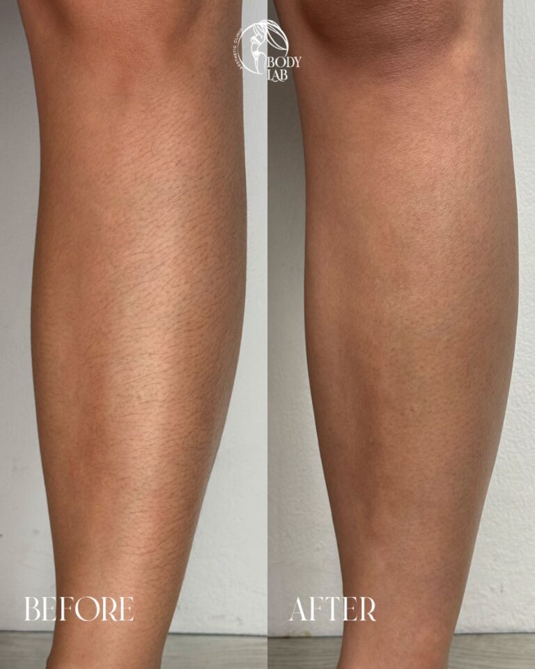 Laser Hair Removal