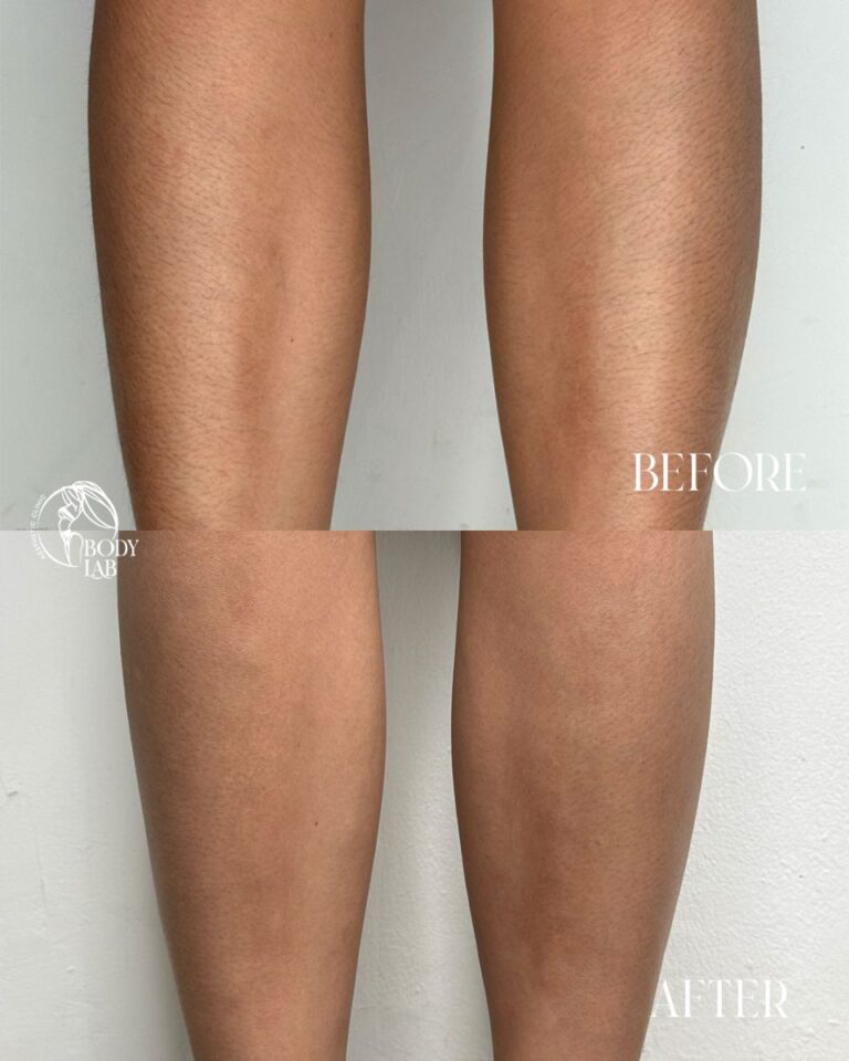 Laser Hair Removal