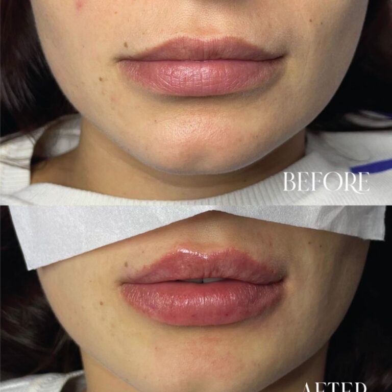 Lip Filler