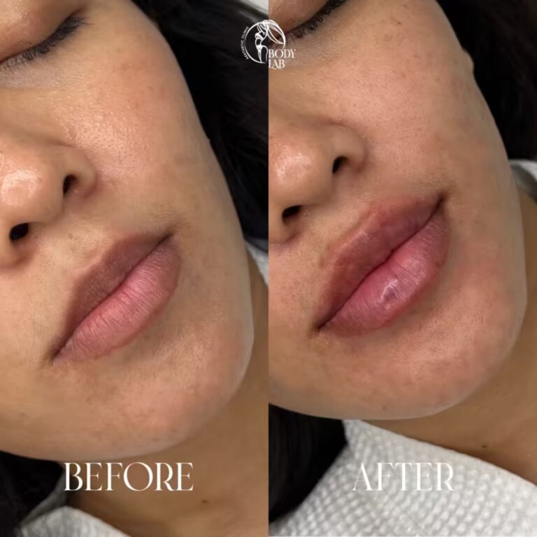 Lip Filler