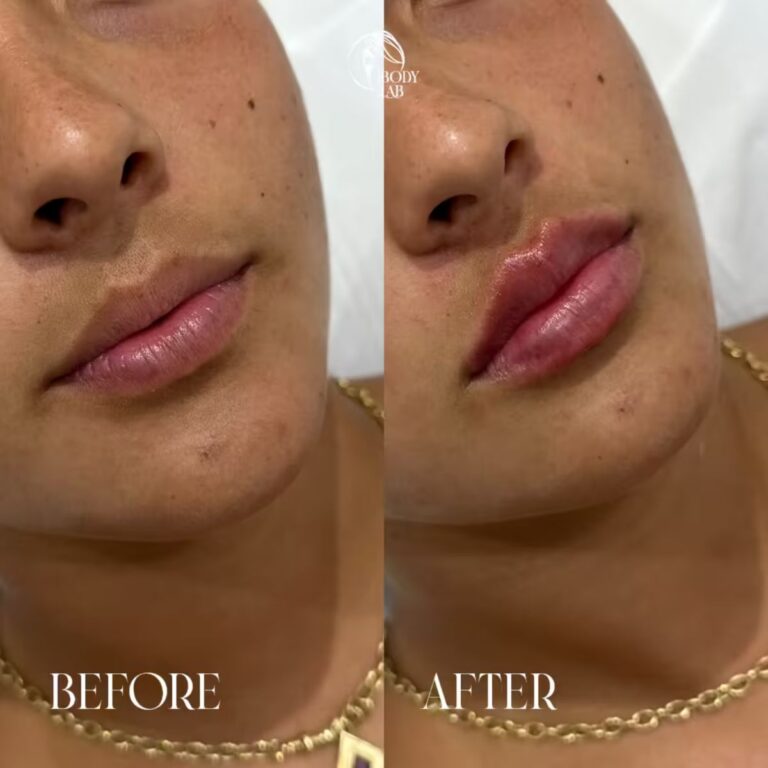Lip Filler
