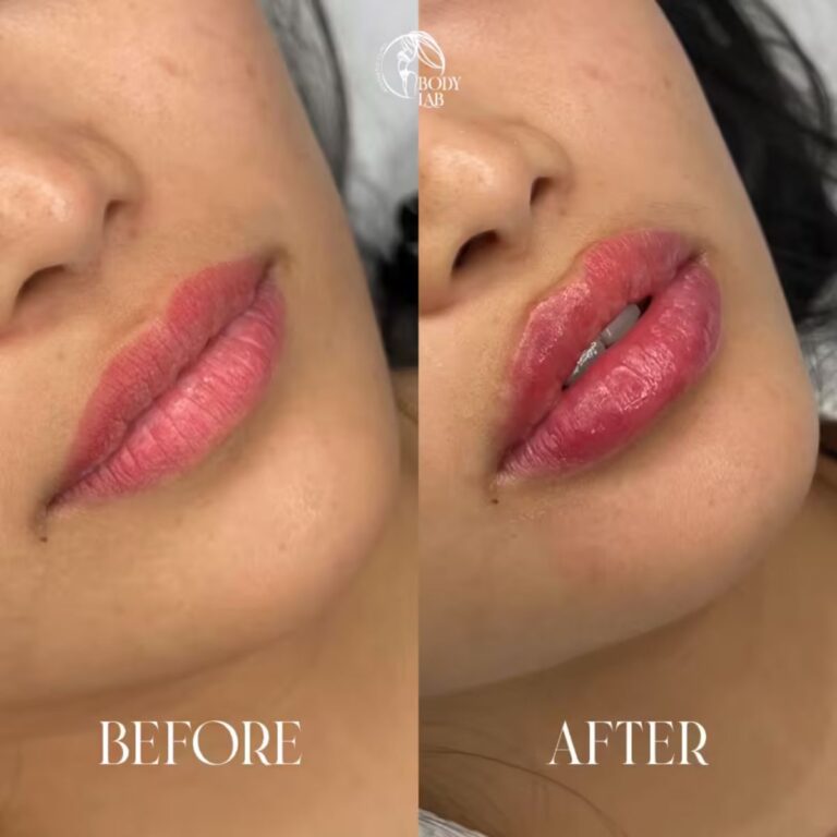 Lip Filler
