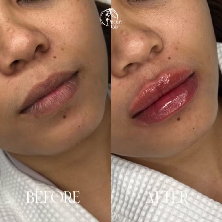 Lip Filler