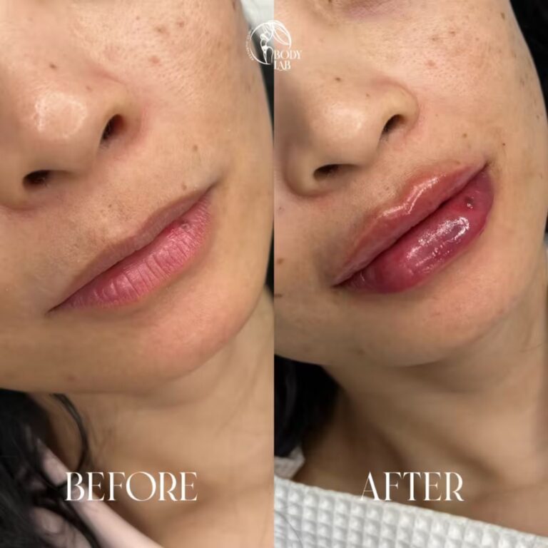 Lip Filler