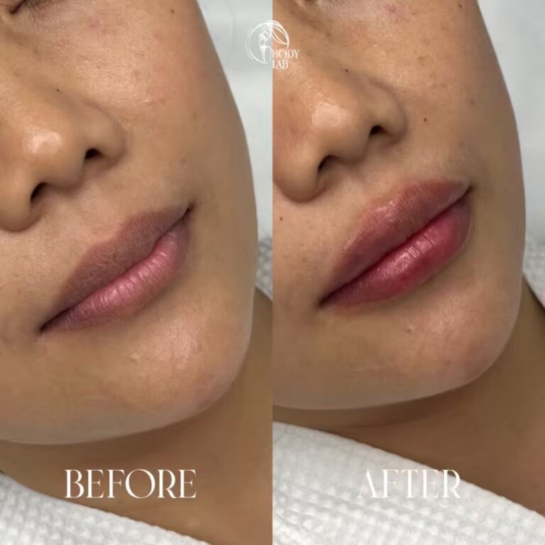 Lip Filler