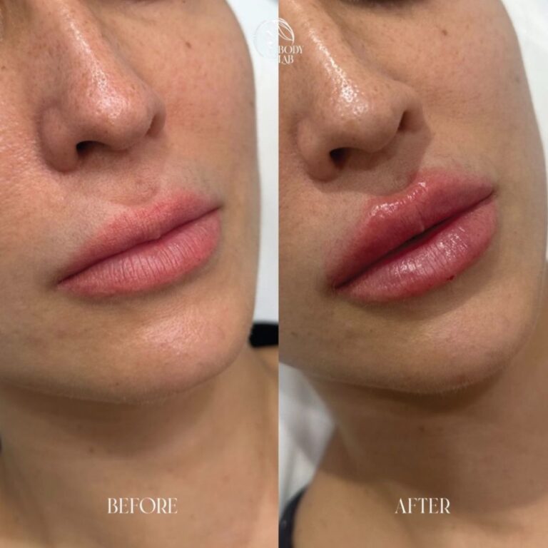 Lip Filler