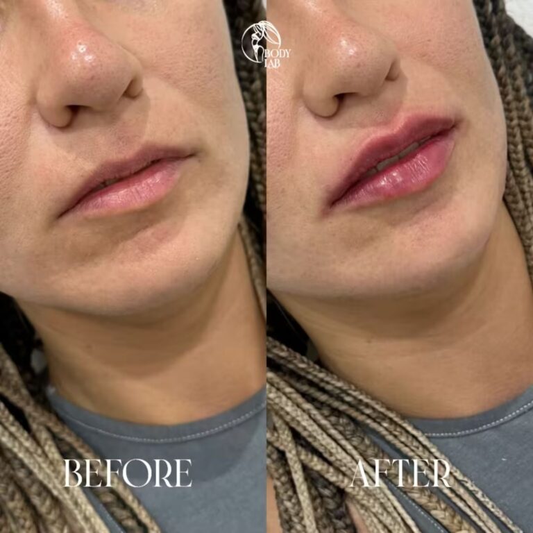 Lip Filler