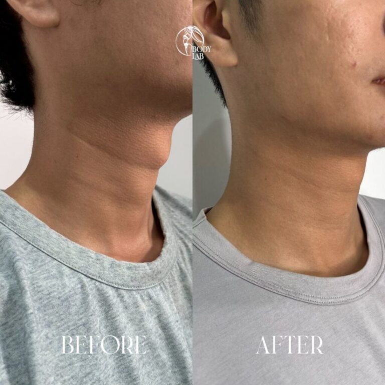 Dermal Fillers