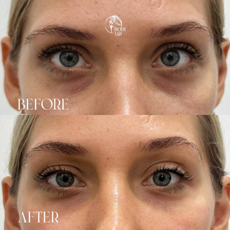 Under Eye Filler