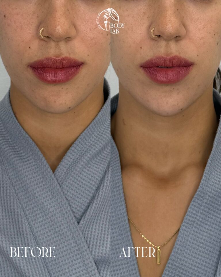 Chin Filler